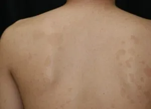 癜風(でんぷう)はカビが原因!?マラセチア菌の正体と再発を防ぐための正しい対策とは